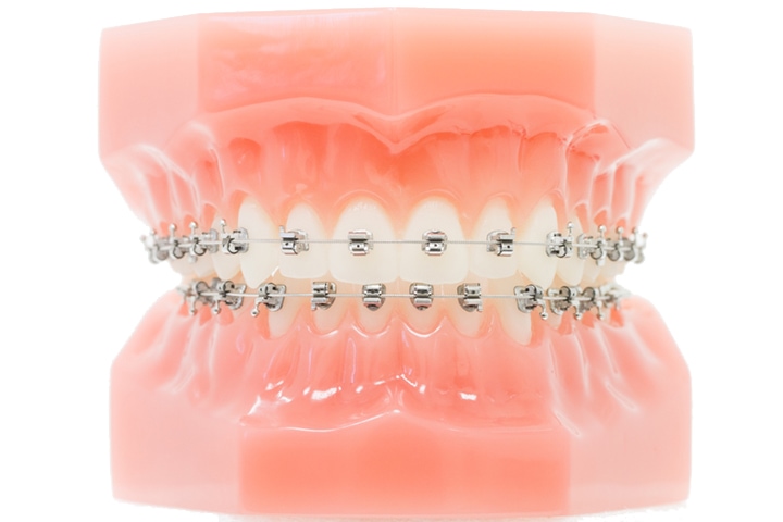 Material Zahnspange: Alles zu Vor- & Nachteilen