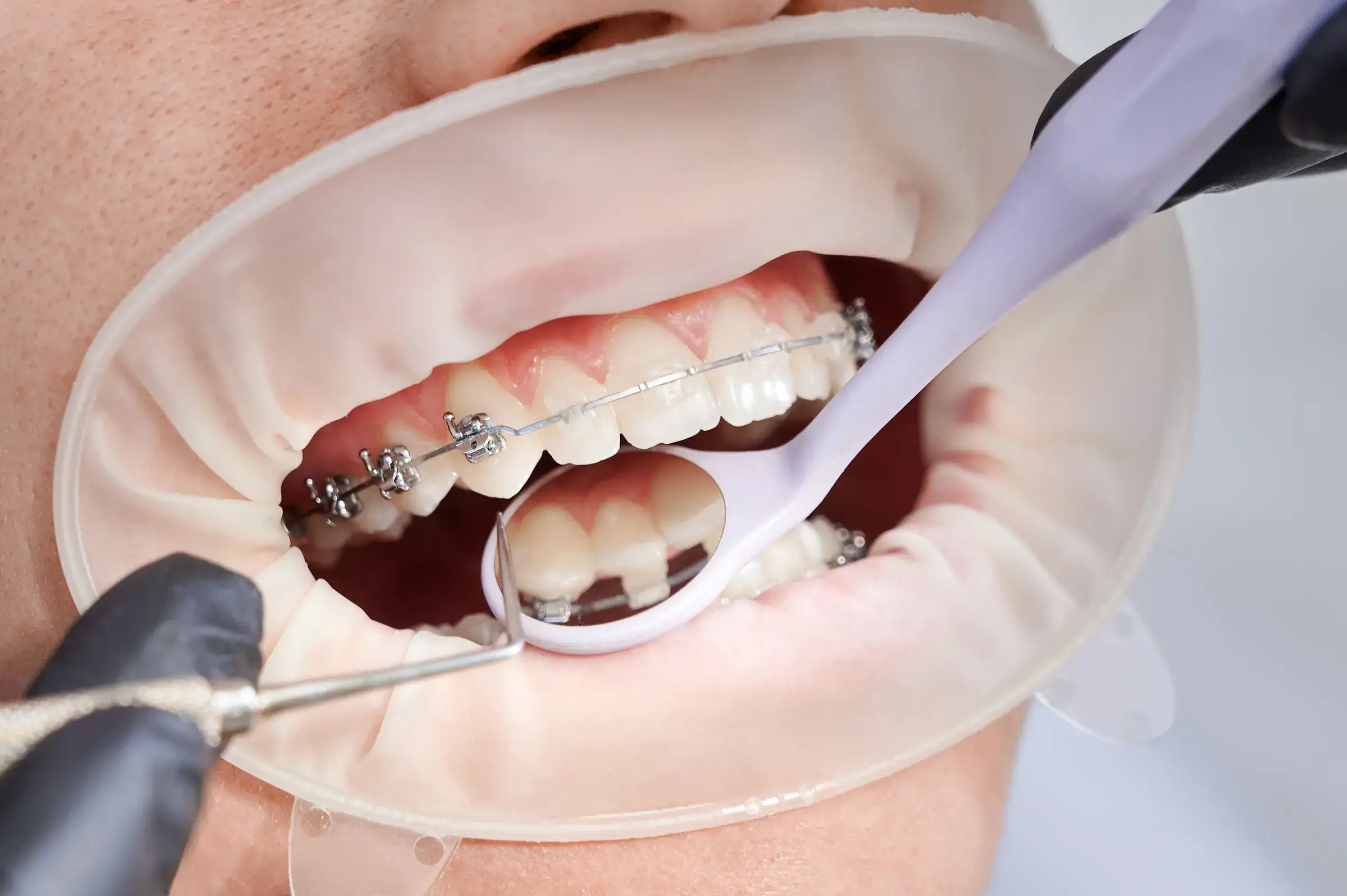Bei einem Patienten werden beim Kieferorthopäden die Brackets angebracht - wie werden die Brackets angebracht?