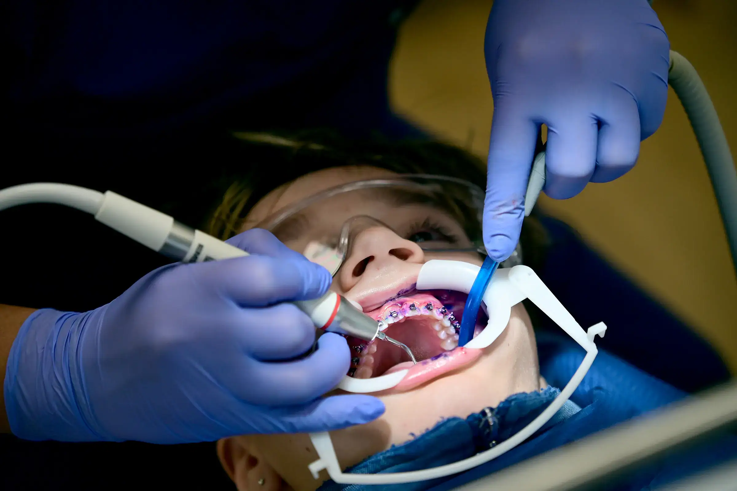 Feste Zahnspange einsetzen bei Zahnfreude Kieferorthopädie Köln