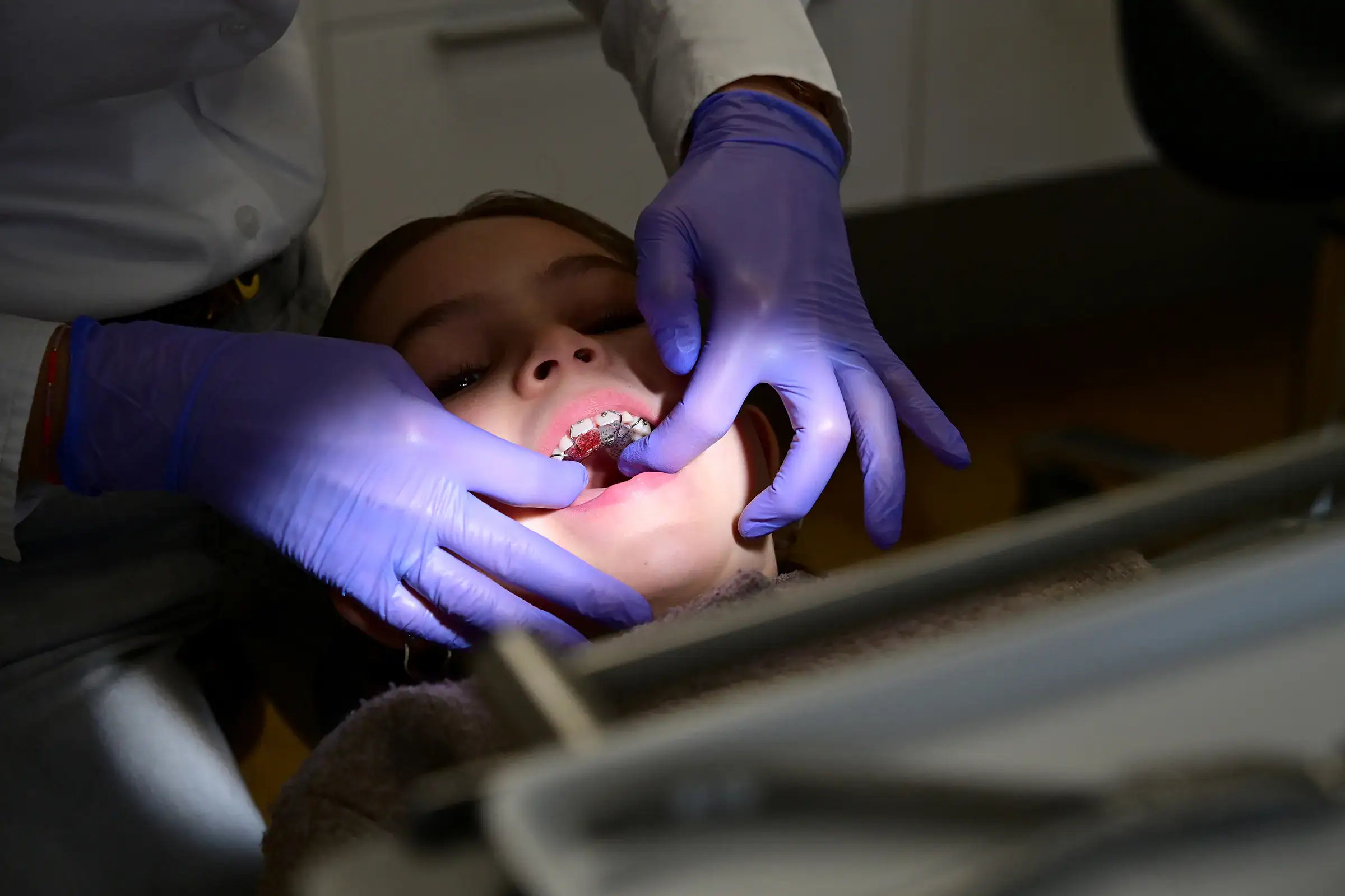 Lose Zahnspange wird eingesetzt – Zahnfreude Kieferorthopäde Köln