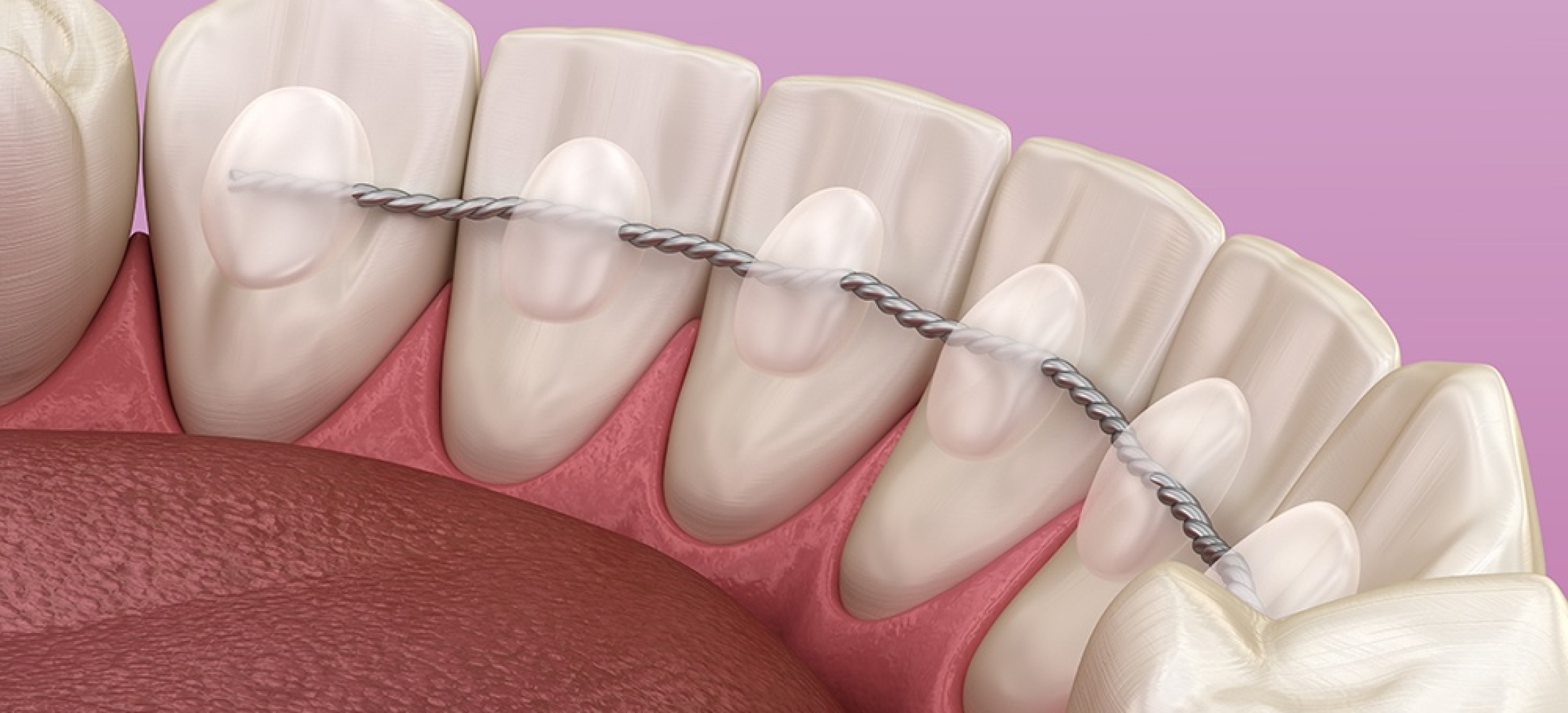 Wie Lange Sollte Ein Retainer Drin Bleiben Stabilisierung Retainer • Zahnfreude